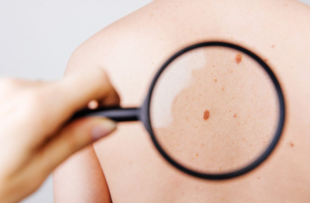 DermaDetect enables to diagnose skin conditions using a dedicated, AI-based app. Photo by Vulp via Shutterstock.com